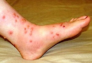 Foot Eczema Causes Symptoms Treatment Foot Pain Explored Foot Eczema Causes Symptoms Treatment Foot Pain Explored