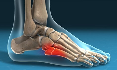 Jones fracture foot 471 opt oct 24