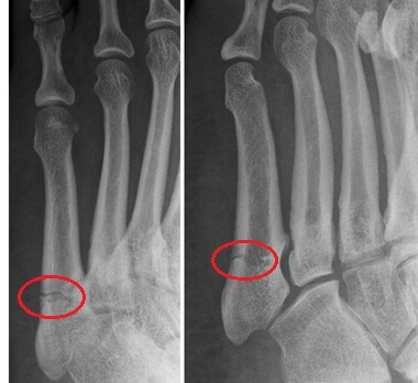 Jones Fracture Xray: Diagnosing Jones Fractures Jones Fracture Xray: Diagnosing Jones Fractures
