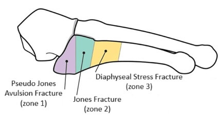 Jones vs Pseduo Jones Fractures: Avulsion fractures occur in zone 1 of the fifth metatarsal base, Jones fractures occur in zone 2.