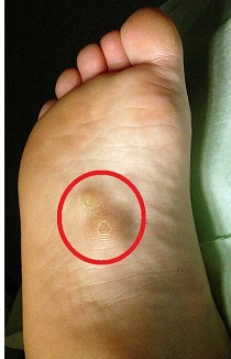 sore spot on sole of foot