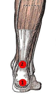 Locations: 1) Insertional Achilles Tendonitis. 2) Non-insertional Achilles Tendonitis