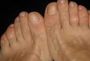 Lump Or Bump On Toes: Causes, symptoms, diagnosis and treatment