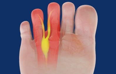 Morton's Neuroma Lump On Bottom Of Foot: Common causes, symptoms & treatment options