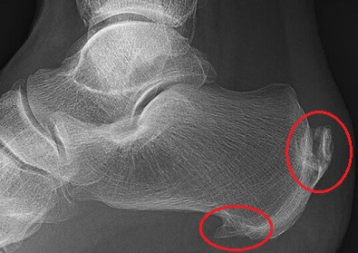Lump In Heel Of Foot: Posterior Heel Spur (Haglund's Deformity) and Inferior Calcaneal Spur Lump In Heel Of Foot: Posterior Heel Spur (Haglund's Deformity) and Inferior Calcaneal Spur