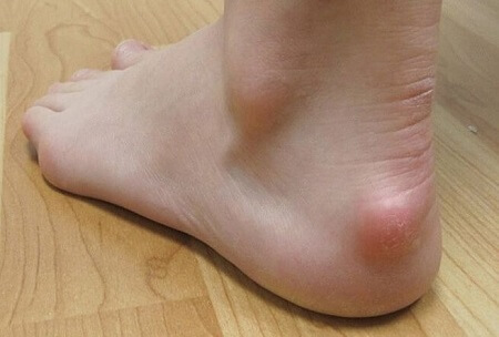 Premium Photo | Foot injury from heel pain, ankles and bones from  inflammation of tendons.