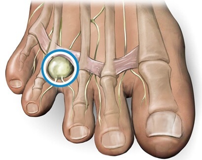 A Hard Lump Under Toe is often due to a Morton's Neuroma. Find out about the causes, symptoms, diagnosis and treatment of hard bump on toe