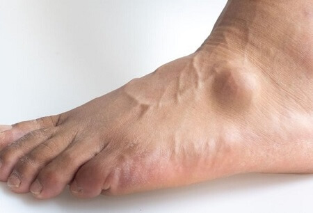 Lump Top Of Foot: Common Causes & Treatment