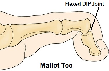 Presentation of Mallet Toe - flexed distal interphalangeal joint