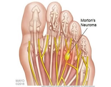 Metatarsal pain is often linked with Morton's Neuroma. Find out about the common causes, symptoms and treatment options