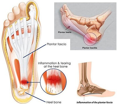 Symptoms of Foot Neuropathy: How to Identify - Vertigo Detective
