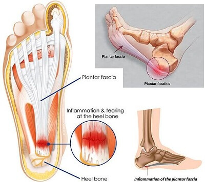 Heel Pain - Symptom Evaluation - Causes, Diagnosis, Treatment, Helth Tips,  FAQs