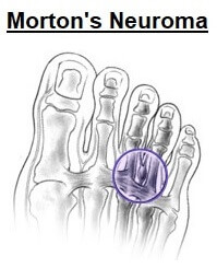 Morton's Neuroma commonly causes pain, tingling and numbness between the toes. Image source https://orthoinfo.aaos.org/en/diseases--conditions/mortons-neuroma