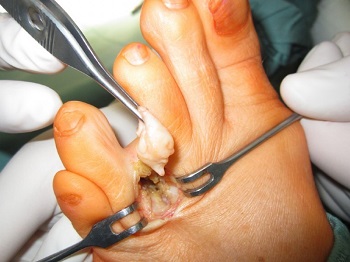 Surgery to remove mortons neuroma growth in the foot Surgery to remove mortons neuroma growth in the foot