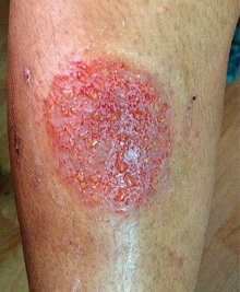 Nummular eczema presents as coin-shaped lesions on the skin