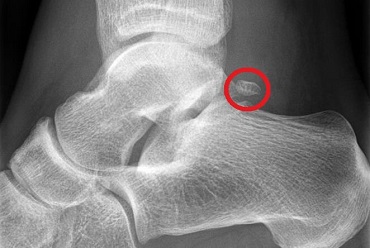 X-ray showing Os Trigonum os trig xray 370 opt jan 23