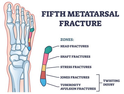 Fifth metatarsal fractures are a common cause of outer foot pain, usually caused by repeated stress through the foot. Find out about the causes, symptoms, diagnosis & treatment options Fifth metatarsal fractures are a common cause of outer foot pain, usually caused by repeated stress through the foot. Find out about the causes, symptoms, diagnosis & treatment options