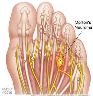 Ball Of Foot Pain: Causes & Treatment - Foot Pain Explored