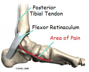 tendonitis bottom of foot