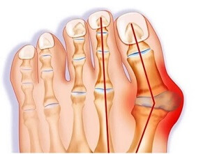 Lump On Side Of Foot: Bunions. Causes, symptoms, diagnosis and treatment of pain on inside of foot Lump On Side Of Foot: Bunions. Causes, symptoms, diagnosis and treatment of pain on inside of foot