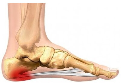 Inner Arch Foot Pain: Plantar Fasciitis. Common causes, symptoms and treatment of pain on inside of foot