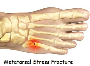 outside foot pain