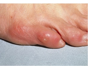 outside foot pain