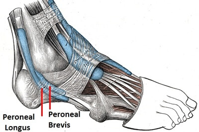 Peroneal Tendon Anatomy: Peroneal tendonitis is caused by irritation and inflammation of the peroneal tendons - peroneal longus and peroneal brevis