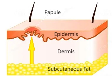 Piezogenic Papules Cause: Weakness in the connective tissue of the dermis allows subcutaneous fat to protrude through forming small lumps underneath the skin