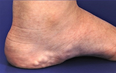 Lump On Side Of Foot Common Causes And Treatment Options The Best