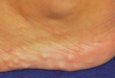 Lumps On Side Of Foot: Piezogenic Pedal Papules