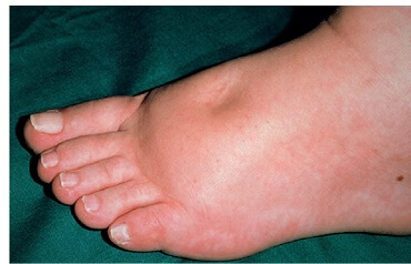 Why Are My Feet Swollen Foot Pain Explored Why Are My Feet Swollen Foot Pain Explored