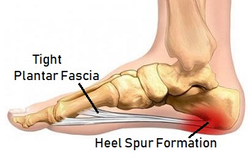 sharp pain in heel bone