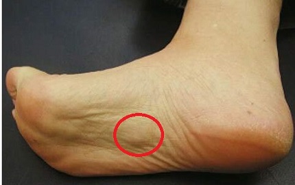 Foot Pain Explored