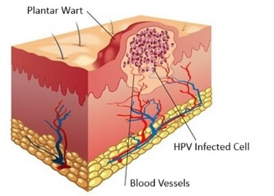 Plantar Wart On Foot: How the HPV virus infects the foot resulting in verruca vulgaris formation Plantar Wart On Foot: How the HPV virus infects the foot resulting in verruca vulgaris formation