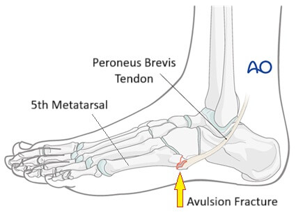 Fifth Metatarsal Avulsion Fracture: Causes, symptoms, diagnosis and treatment of a Pseudo Jones fracture of the foot