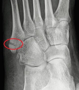 Pseudo Jones Fracture: This x-ray shows an avulsion fracture of the fifth metatarsal