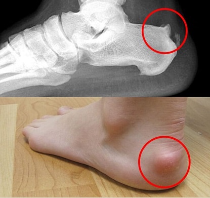 Heel Spur: Causes, Symptoms, Treatment and Cost