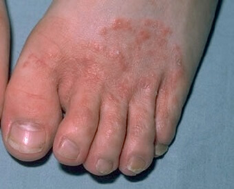 Foot Rash Causes Symptoms Treatment