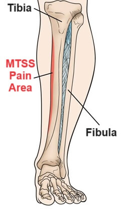 Shin Splints Pain: typical location of pain from medial tibial stress syndrome Shin Splints Pain: typical location of pain from medial tibial stress syndrome