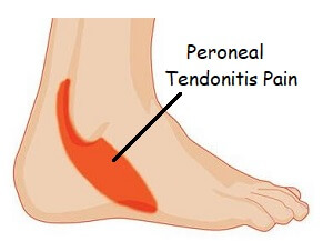 outside foot pain