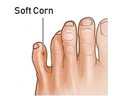 corn on inside of pinky toe