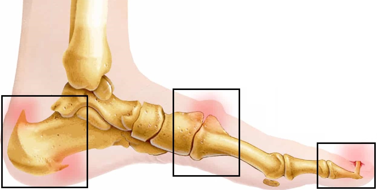 Bone spurs often cause pain in the foot when walking. Find out about the causes, symptoms and treatment options Bone spurs often cause pain in the foot when walking. Find out about the causes, symptoms and treatment options