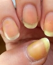 Yellow Toenails: Causes & Treatment - Foot Pain Explored Yellow Toenails: Causes & Treatment - Foot Pain Explored