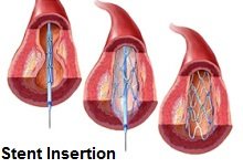 O Stenting é uma opção de tratamento comum utilizado com a síndrome do pé azul