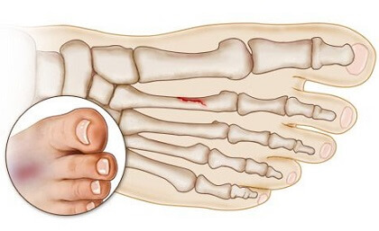 What Is Clutching Feet Syndrome And How TO Recover From It?