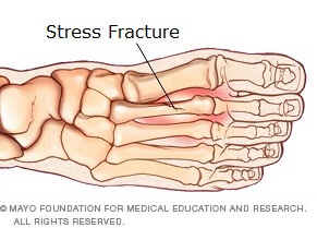 Pain on of Foot: Symptoms &