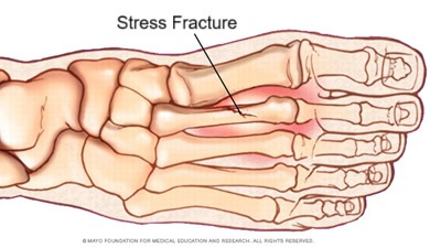 Stress fractures are a common cause of pain on top of the foot. Find out about the causes, symptoms, diagnosis & treatment options