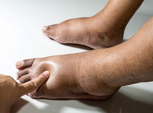 Piedi e caviglie gonfi: Cause comuni, sintomi, diagnosi e opzioni di trattamento