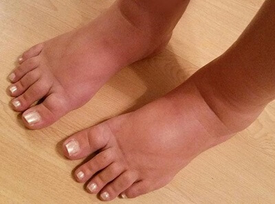 swollen ankles and heel pain